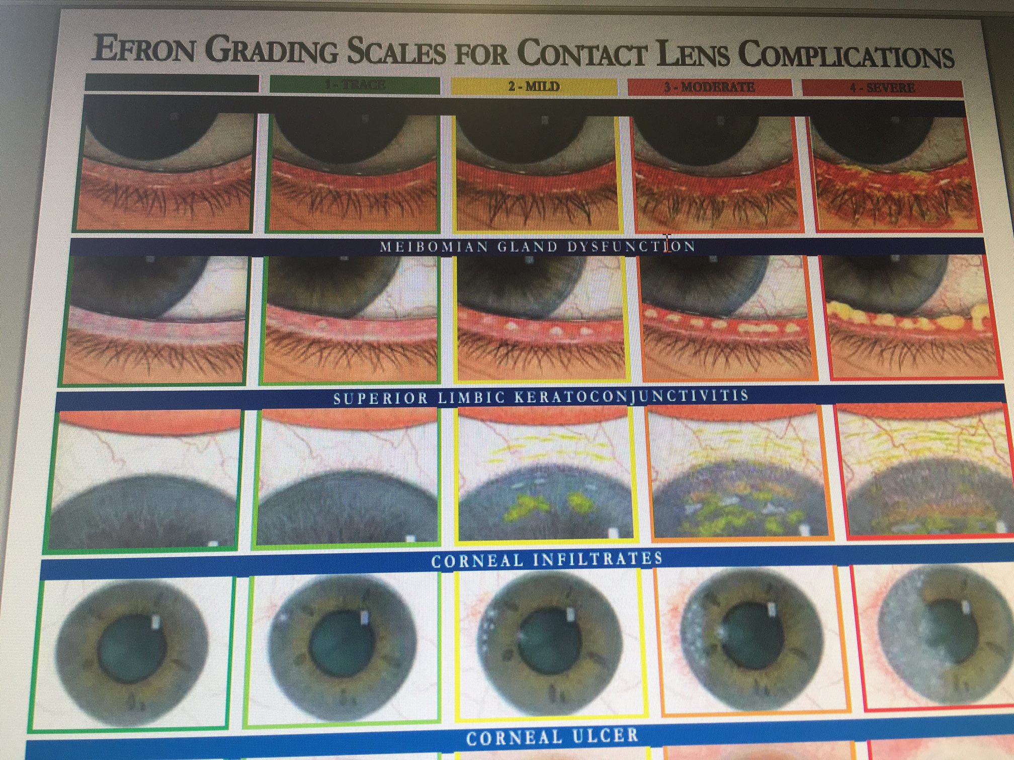 contact-lens-grading-scale